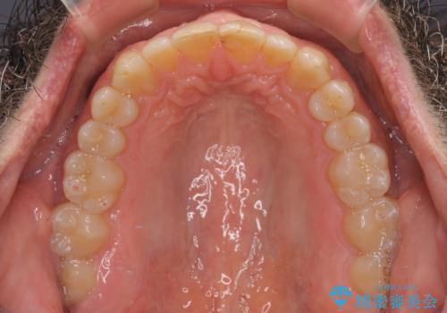 【モニター】前歯のデコボコを治したい インビザライン矯正治療の治療後