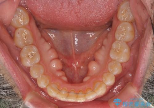 【モニター】前歯のデコボコを治したい インビザライン矯正治療の治療後