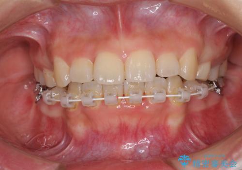 デコボコと膨らんだ口元 ハーフリンガルによる抜歯矯正とインプラント補綴治療の治療中