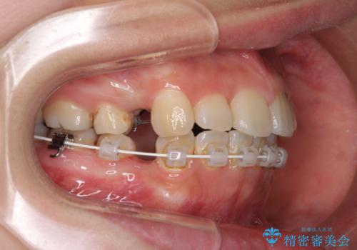デコボコと膨らんだ口元 ハーフリンガルによる抜歯矯正とインプラント補綴治療の治療中