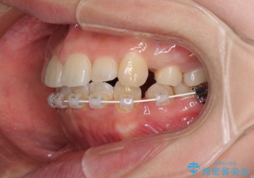 デコボコと膨らんだ口元 ハーフリンガルによる抜歯矯正とインプラント補綴治療の治療中
