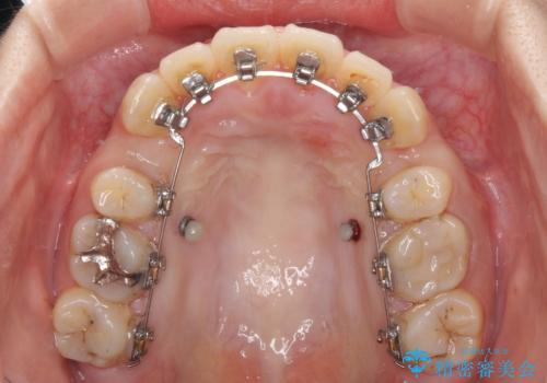 デコボコと膨らんだ口元 ハーフリンガルによる抜歯矯正とインプラント補綴治療の治療中