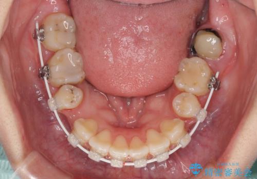 デコボコと膨らんだ口元 ハーフリンガルによる抜歯矯正とインプラント補綴治療の治療中