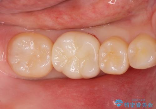 ジルコニアクラウンの治療後