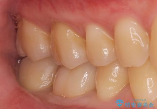 ジルコニアクラウンの治療後