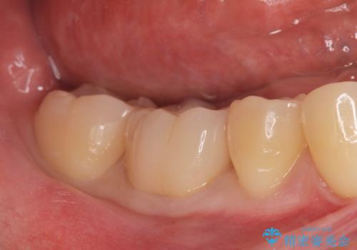 ジルコニアクラウンの治療後
