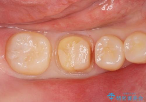 ジルコニアクラウンの治療中