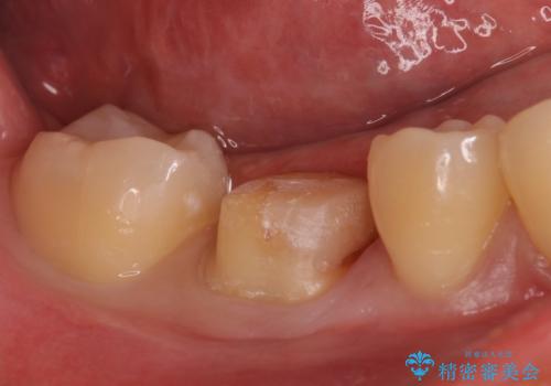 ジルコニアクラウンの治療中