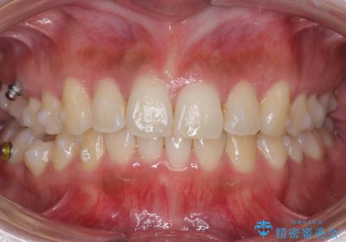 マウスピース矯正では難しい治療にも対応します　歯を抜かない矯正の治療中