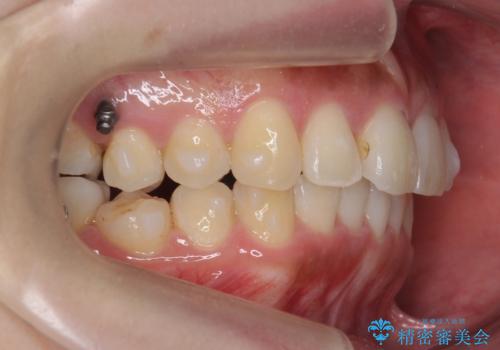 マウスピース矯正では難しい治療にも対応します 歯を抜かない矯正の治療中