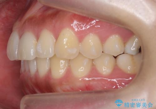 マウスピース矯正では難しい治療にも対応します 歯を抜かない矯正の治療中