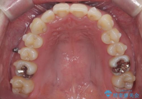 マウスピース矯正では難しい治療にも対応します　歯を抜かない矯正の治療中