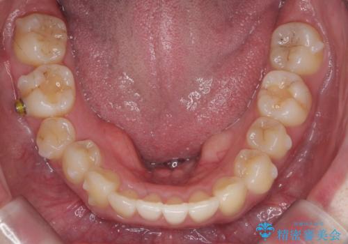 マウスピース矯正では難しい治療にも対応します 歯を抜かない矯正の治療中