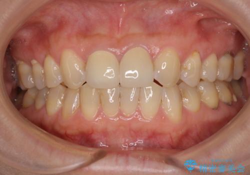 つぎはぎだらけの前歯 オールセラミッククラウンで自然な歯にの治療後