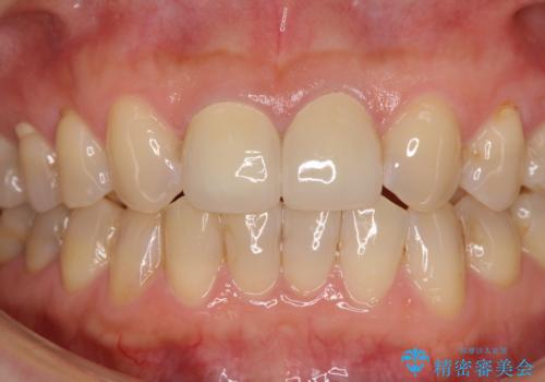 つぎはぎだらけの前歯 オールセラミッククラウンで自然な歯にの治療後