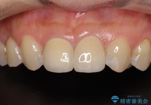 つぎはぎだらけの前歯 オールセラミッククラウンで自然な歯にの症例 治療後
