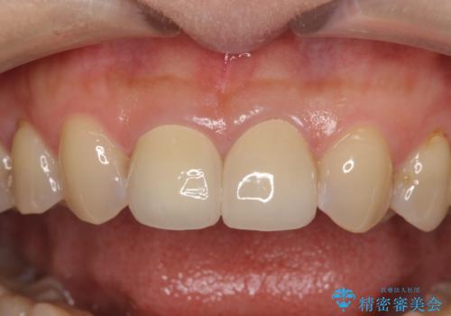 つぎはぎだらけの前歯 オールセラミッククラウンで自然な歯にの治療後