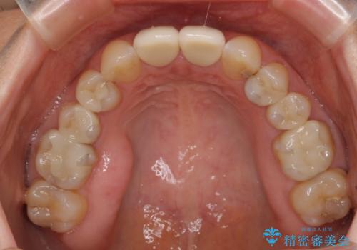つぎはぎだらけの前歯 オールセラミッククラウンで自然な歯にの治療後