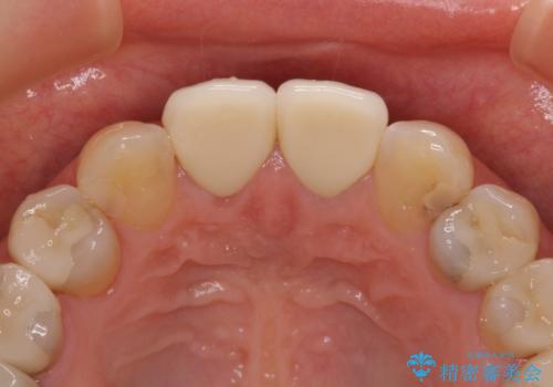 つぎはぎだらけの前歯 オールセラミッククラウンで自然な歯にの治療後
