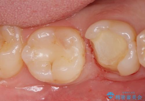 詰め物が欠けてしみるの治療中