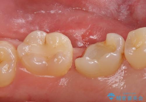 詰め物が欠けてしみるの治療中