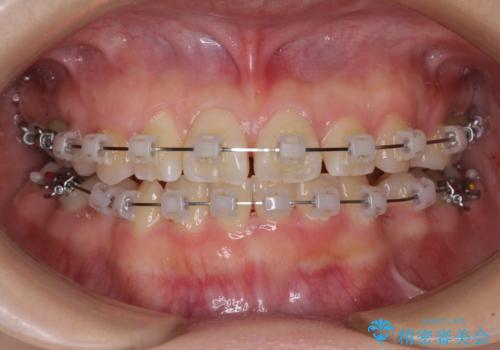 重度叢生と埋もれた奥歯 8本を抜歯したワイヤー矯正の治療中