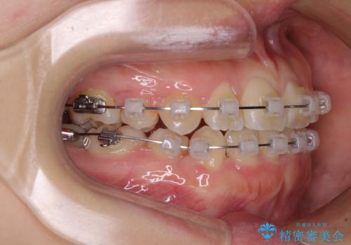 重度叢生と埋もれた奥歯 8本を抜歯したワイヤー矯正の治療中