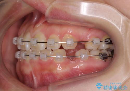 重度叢生と埋もれた奥歯 8本を抜歯したワイヤー矯正の治療中