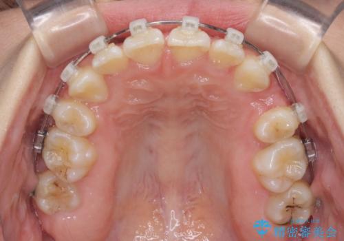 重度叢生と埋もれた奥歯 8本を抜歯したワイヤー矯正の治療中