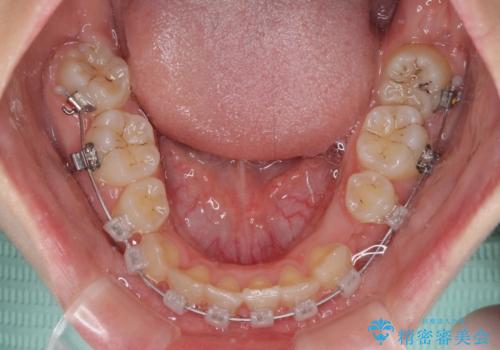 重度叢生と埋もれた奥歯 8本を抜歯したワイヤー矯正の治療中