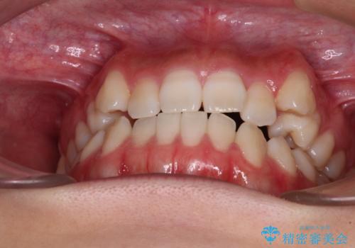 【モニター】上顎が狭い 急速拡大装置を用いたデコボコの解消の治療前