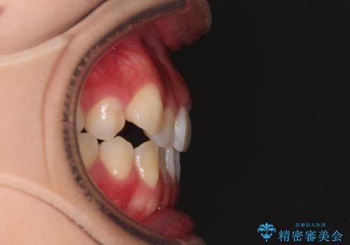 【モニター】上顎が狭い 急速拡大装置を用いたデコボコの解消の治療前