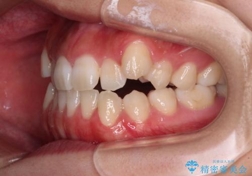 【モニター】上顎が狭い 急速拡大装置を用いたデコボコの解消の治療前