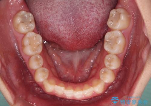 【モニター】上顎が狭い 急速拡大装置を用いたデコボコの解消の治療前
