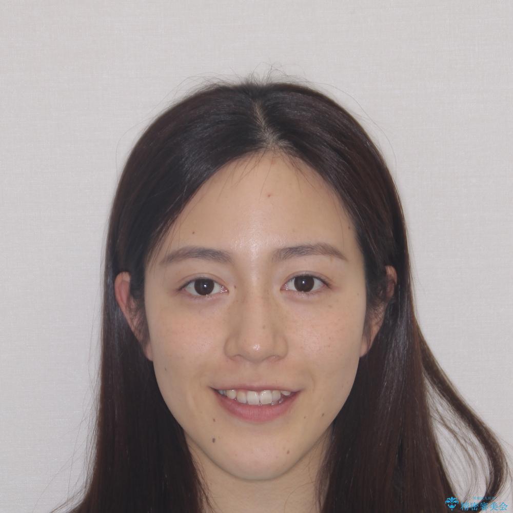 【モニター】上顎が狭い 急速拡大装置を用いたデコボコの解消の治療前(顔貌)