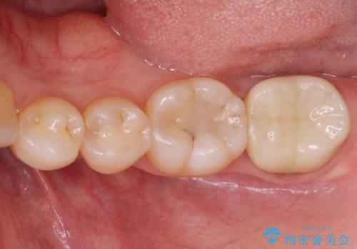 歯の噛む面が黒い。の治療前