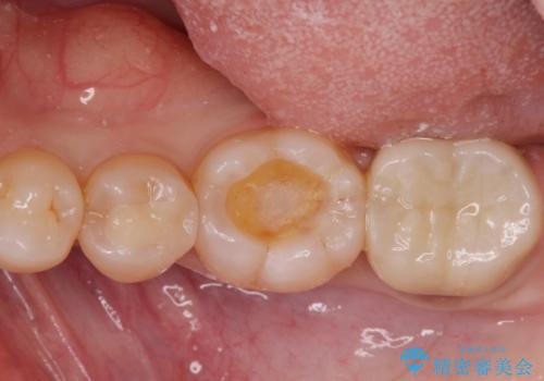歯の噛む面が黒い。の治療中