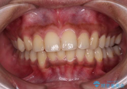 深い咬み合わせと前歯のデコボコ インビザラインによる矯正治療の治療中