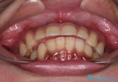 深い咬み合わせと前歯のデコボコ インビザラインによる矯正治療の治療中