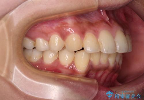 深い咬み合わせと前歯のデコボコ インビザラインによる矯正治療の治療中
