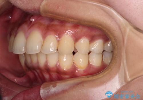深い咬み合わせと前歯のデコボコ　インビザラインによる矯正治療の治療中