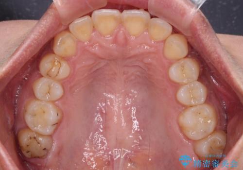 深い咬み合わせと前歯のデコボコ インビザラインによる矯正治療の治療中