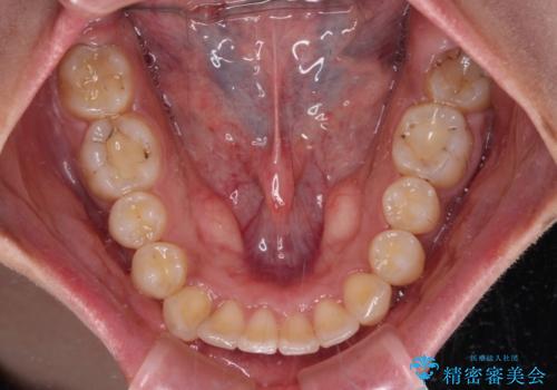深い咬み合わせと前歯のデコボコ　インビザラインによる矯正治療の治療中