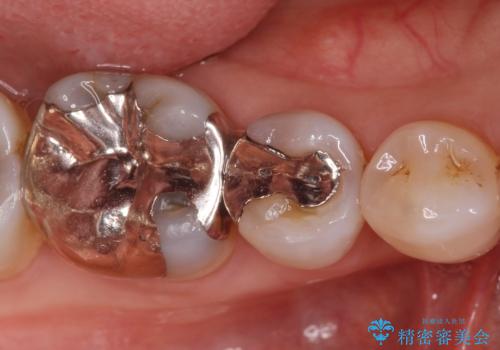 口を開けると銀歯が見えるのが嫌だ。の治療前