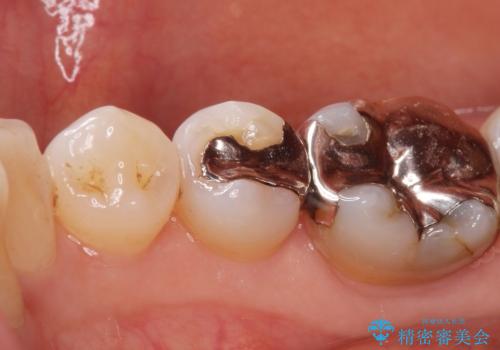 口を開けると銀歯が見えるのが嫌だ。の治療前