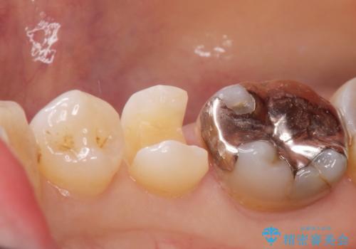 口を開けると銀歯が見えるのが嫌だ。の治療中