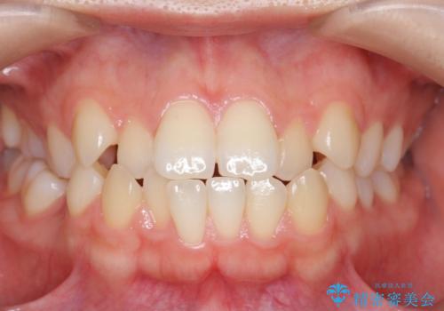 かみ合わせが悪いところを ワイヤー矯正でしっかり治療 マウスピース矯正は難しい症例の治療前