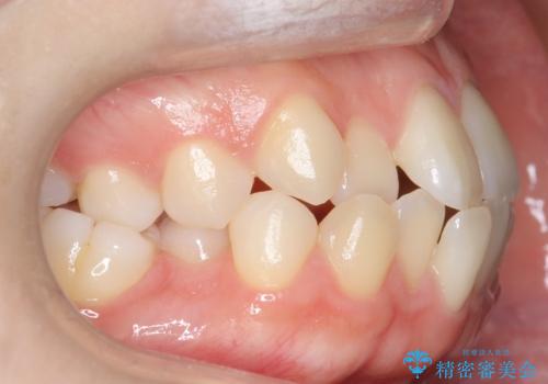 かみ合わせが悪いところを ワイヤー矯正でしっかり治療 マウスピース矯正は難しい症例の症例 治療前
