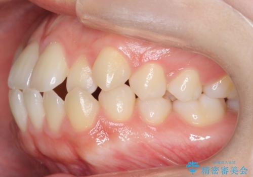 かみ合わせが悪いところを ワイヤー矯正でしっかり治療 マウスピース矯正は難しい症例の治療前