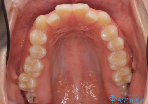 かみ合わせが悪いところを ワイヤー矯正でしっかり治療 マウスピース矯正は難しい症例の治療前